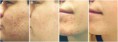 /album/fotogalerie-chemicky-peeling/akne-po-chem-p-jpg/